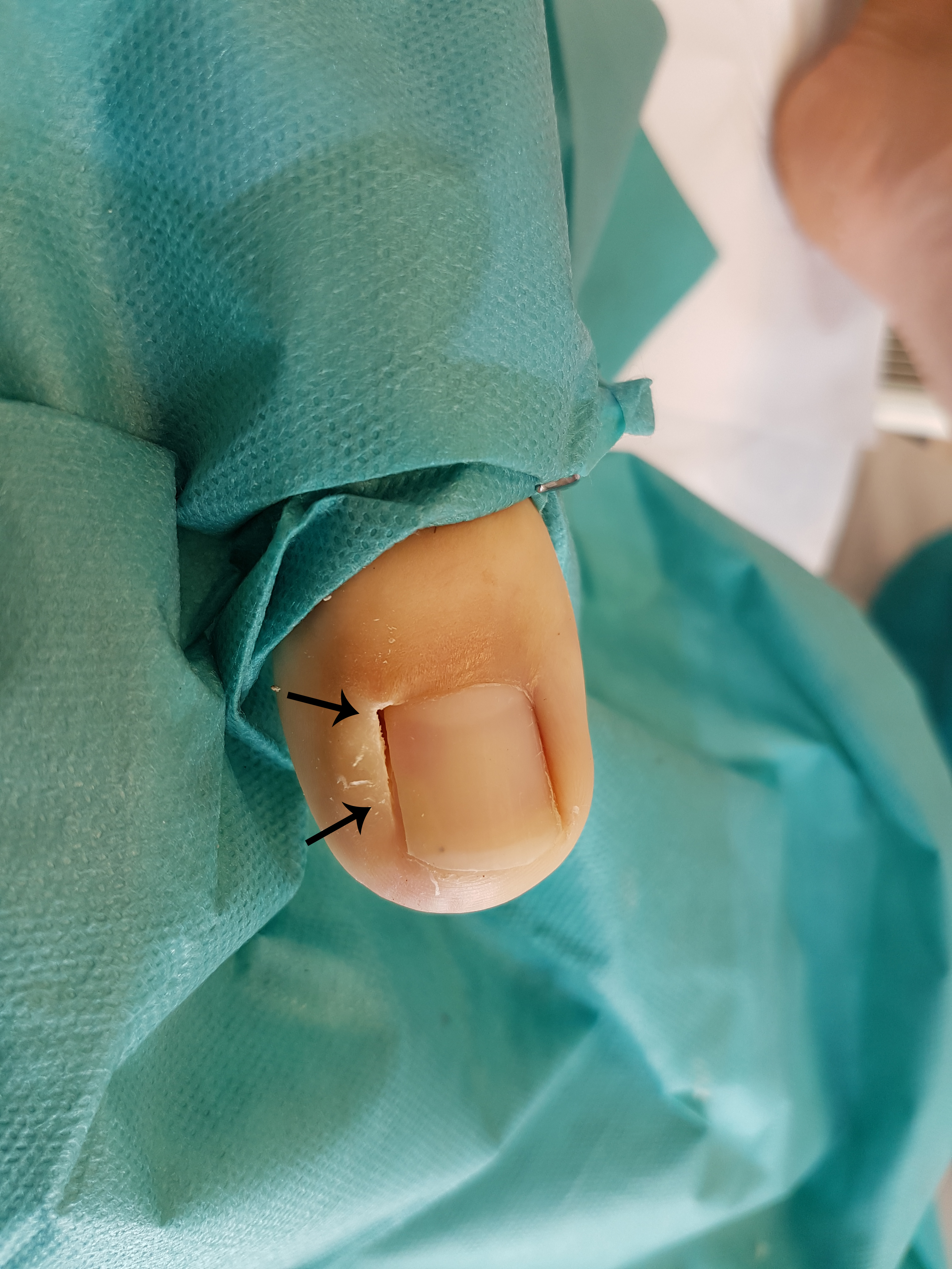 Zehennagel direkt nach CO₂-Laserbehandlung – präzise Entfernung des Nagelbettanteils